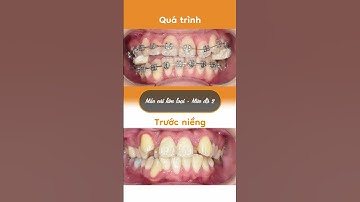 Hành trình LỘT XÁC nhờ niềng răng của Ninh Kiều