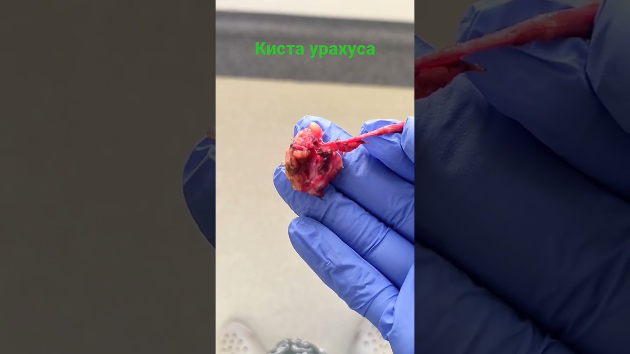 киста урахуса. макропрепарат