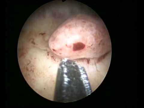 hysteroscopic-removal-of-endometrial-polyp-with-scissors-a015.wmv