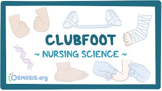 Clubfoot: Clinical Nursing Care screenshot 4