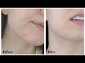 How to Cover Pimples and Blemishes for Beginners