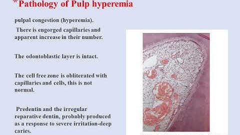 pulpitis lec 3 Thabat 2020 video