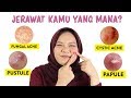 Jerawat Cystic: Mengetahui Penyebab di Balik Kulit Bermasalah