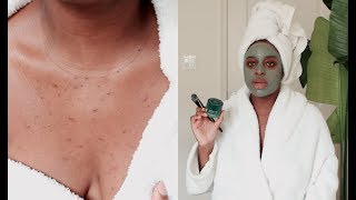 My Simple Pregnancy Skincare Routine: Chest acne, Stretch Marks, Melasma etc