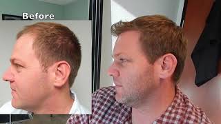 We Transplant Hair YOURS!  Natural Transplants | Hair Transplant Surgery