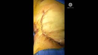 علاج اثار الجروح / ندبات الحروق جراحيا / تحسين اثار جروح و تشوهات الحروق /Post Burn Scar /