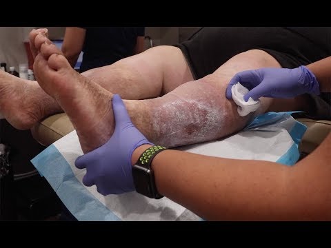 wound-care-episode-#9:-patient-w/-venous-ulcer-&-lymphedema-treated-by-dr.-loan-lam-at-hyper-healing