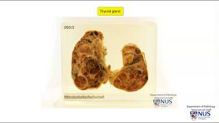 Thyroid multinodular goitre