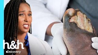 Paciente tem feridas nos pés em &quot;carne viva&quot; | Meus Pés Estão Me Matando | H&amp;H Brasil