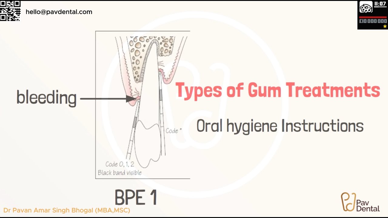 Informed Consent - Oral Hygiene Instruction - Gum Treatment Part 2/3