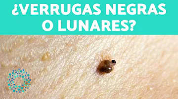 ¿Es contagiosa una verruga negra?