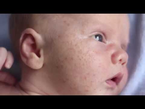 What is Baby Acne? - Boys Town Pediatrics