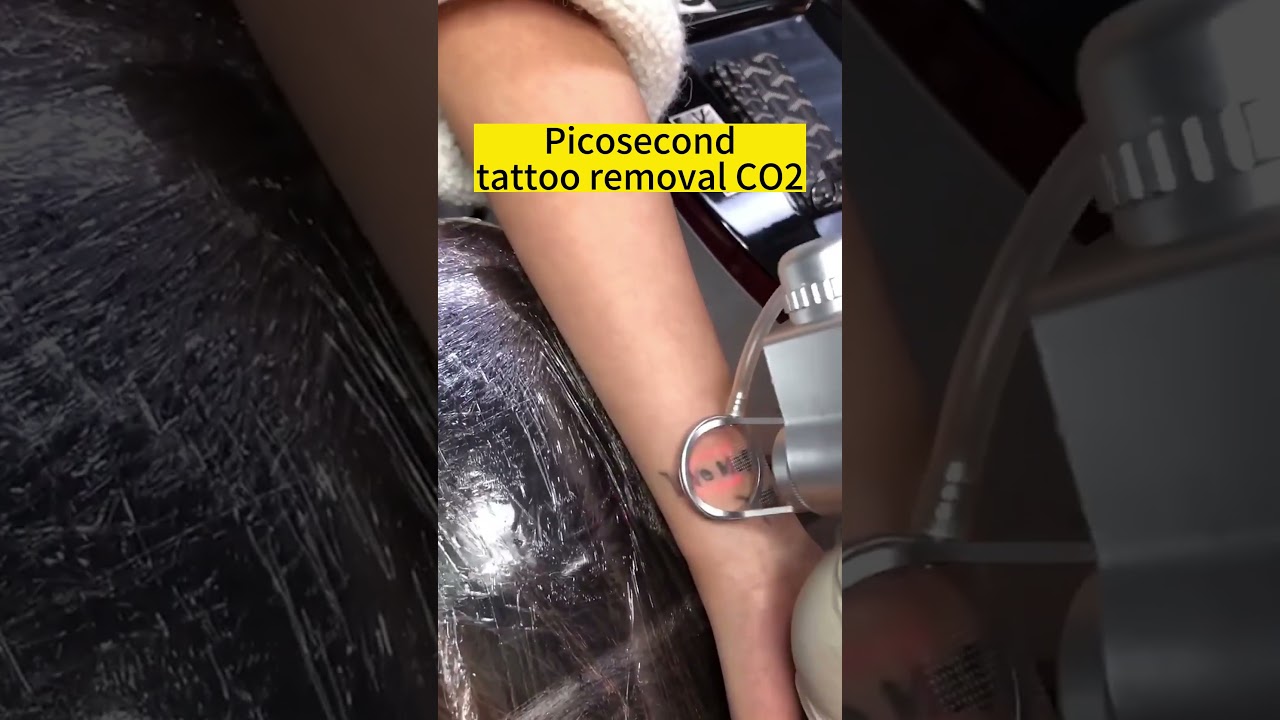 wow, picosecond and co2 laser work together to use tattoo. 