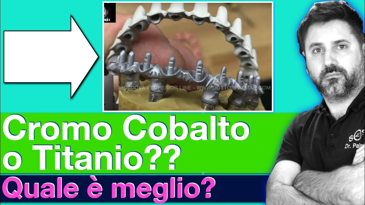 Protesi avvitata su impianti: Meglio lega Cromo e Cobalto o Titanio?
