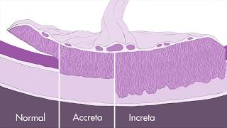 Placenta Accreta Spectrum What to Expect, Placenta Accreta Ireland