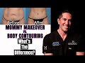 Difference between body contouring and mommy makeover?