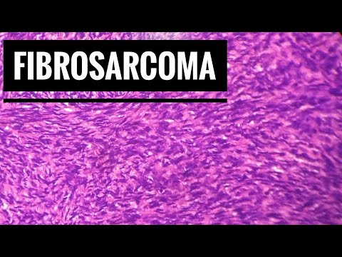 ቪዲዮ: የአጥንት ካንሰር (Fibrosarcoma) በውሾች ውስጥ