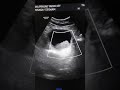 Bladder Mass | Transitional Cell Carcinoma | hematoma Blood clot UTI Doppler Ultrasound Radiology