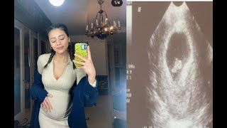 Sıla Ultrasound поделилась изображением: Sıla Türkoğlu беременна?