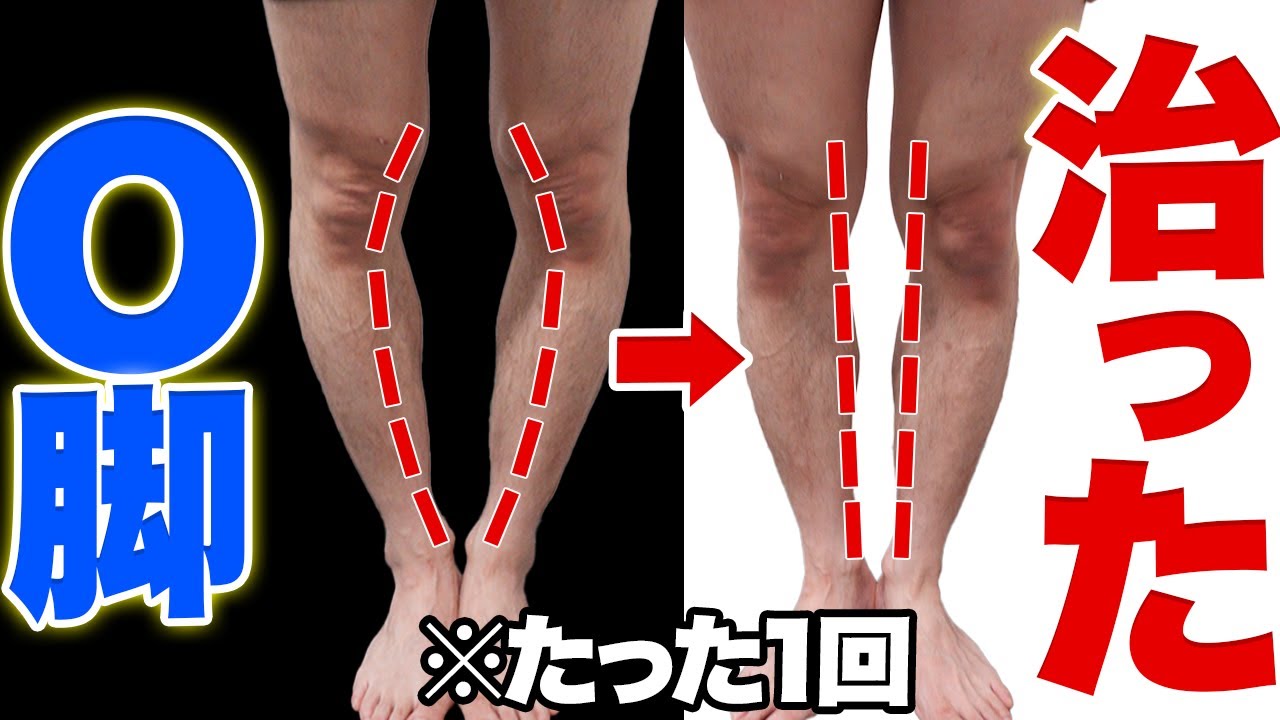 【O脚改善】「30年悩んだ…」たった一撃で？O脚の治し方【整体】