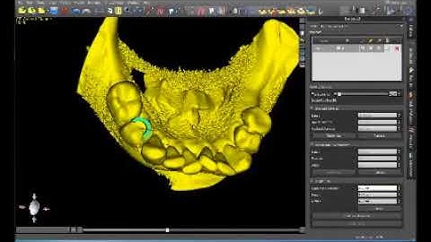 Surgical guide designed in Blue Sky Bio for single tooth replacement