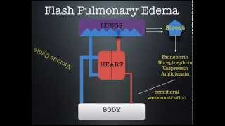 Flash Pulmonary Edema lecture by Dr. Zevallos