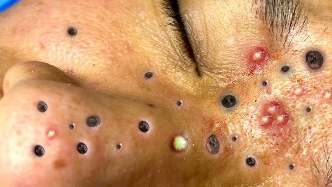 Big Cystic Acne Blackheads Extraction Blackheads & Milia, Whiteheads  Removal Pimple Popping # - YouTube