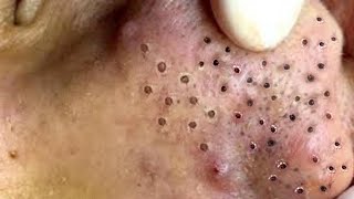 Treatment Satisfying blackhead relaxing  acne, pimple, cyst 10 by FISHING VIDEO 84 views 1 year ago 5 minutes, 4 seconds