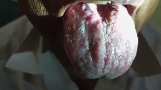 Verrucous Carcinoma on Tongue - Lycopodium Clavatum
