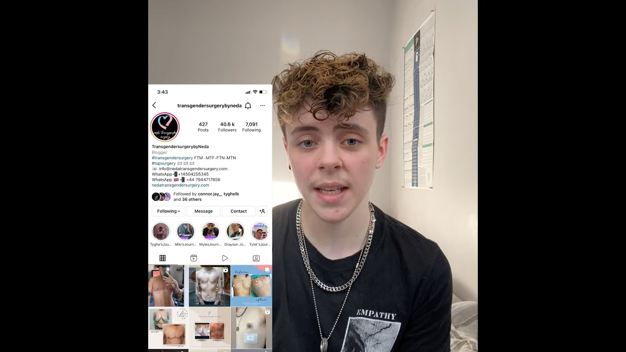 Myles Top Surgery Journey to Turkey. FtM Top surgery, Periareolar top surgery result YouTube