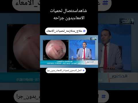 العلاج النهائي للحميات الامعاء بدون جراحه منظار الامعاء الدقيقه