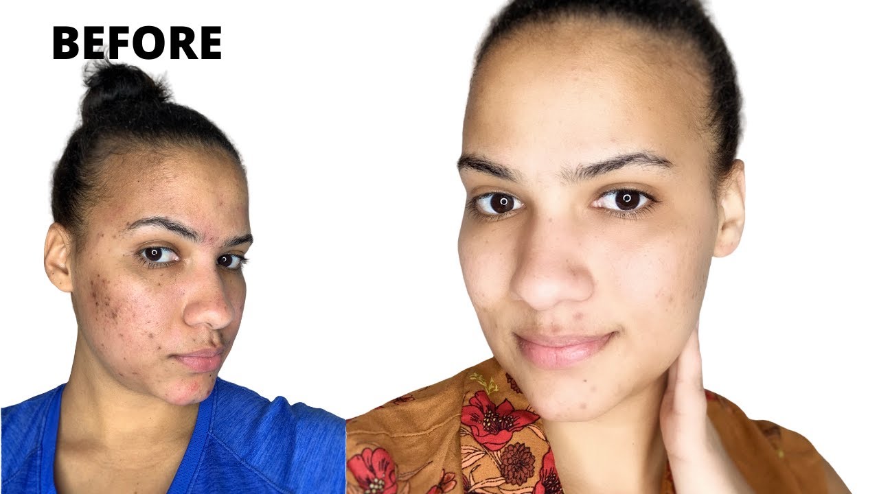 how to get rid of acne scars fast at home