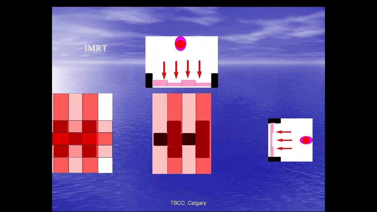 Meningiomas and Radiosurgery