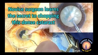 The Secret to Phaco Chop in Dense Cataracts