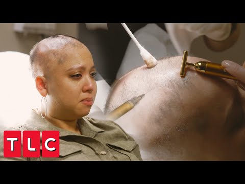 Dr. Lopez Treats Alopecia with Painful PRP Injections | Bad Hair Day
