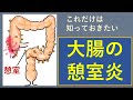 【医師解説】これだけ知っておけばOK。大腸憩室炎の治療、2021版