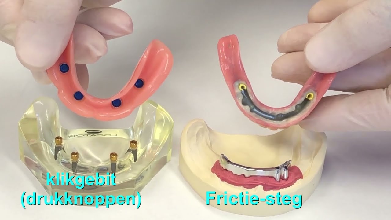 Klikgebit of Frictie-steg?