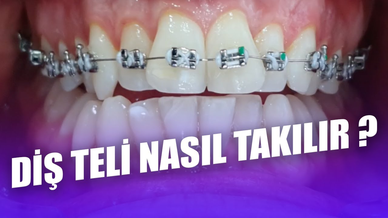 Diş Teli Nasıl Takılır? Ortodontik Tel Tedavisi Nedir? Ortodonti Tel Tedavisi Nasıl Yapılır?
