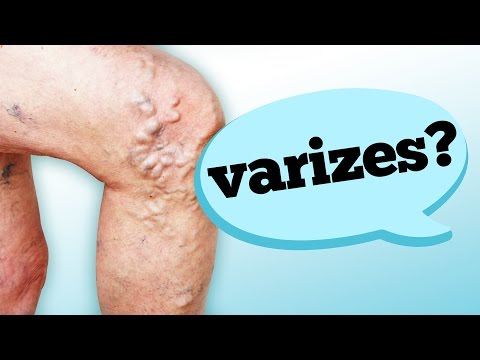 Vídeo: As varizes são varizes?