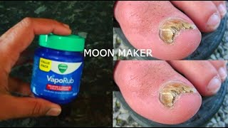 MAGIC VICKS | Nail Fungus |  How to  Cure Toenail Fungus At Home | Best Remedy For Toenail Fungus |