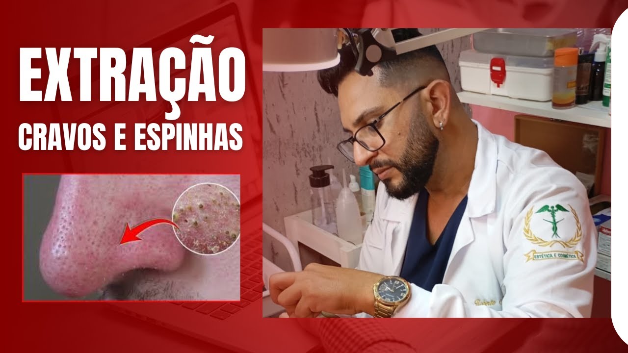 como e feito a extração de cravos e espinhas - YouTube