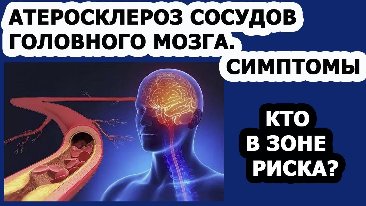 Помочь сосудам головы. Атеросклероз сосудов головного МОЗ. Атеросклероз сосудов головного мозга симптомы. Атеросклероз артерий мозга. Атероматоз сосудов головного мозга.