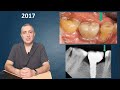 Почему появляются щели между зубами и имплантами?