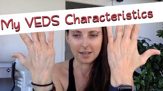 My VEDS Characteristics and Diagnosis Story - My Life with VEDS (Vascular Ehlers-Danlos syndrome)