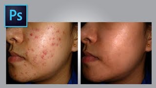Pincel Corrector - Cómo quitar acné | Photoshop | Tutorial 25 😶