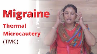 Ayurvedic treatment for Migraine | Thermal Microcautery | Agnikarma