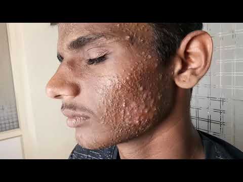 Steroid induced Acne Vulgaris (Dr Bhutada Skin India)