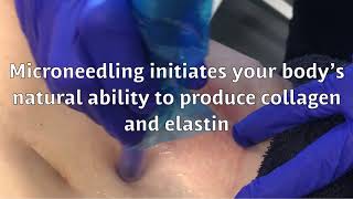 MicroNeedling for Stretch Marks & Scars