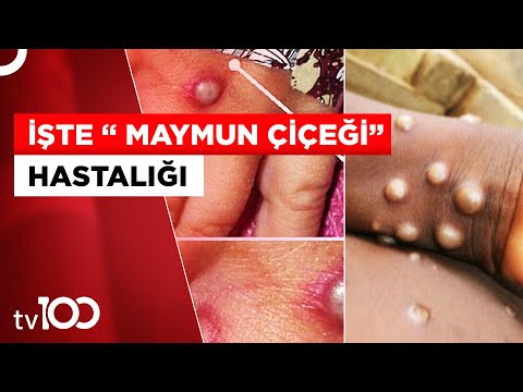 Maymun Çiçeği Virüsünün Bilinmeyenleri