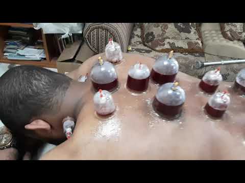 الحجامة النبوية الحجام ماهر البلوشي سلطنة عمان مسقط السيب المعبيلة الجنوبية 92228449 استشارة مجان